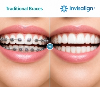 Braces